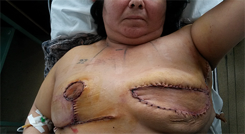  Կրծքագեղձի կիսման կամ Breast-sharing վիրահատություն. կլինիկական դեպք 